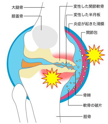 膝痛・変形性膝関節症とは？