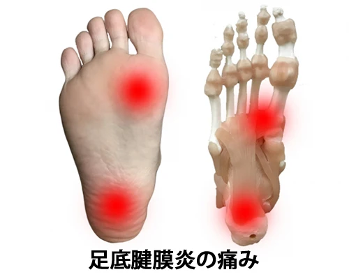足底腱膜炎とは？
