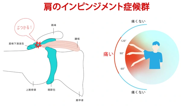 インピンジメント症候群とは？