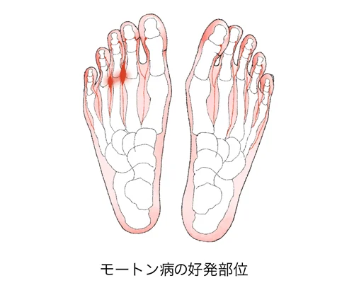 モートン病とはどんな病気？