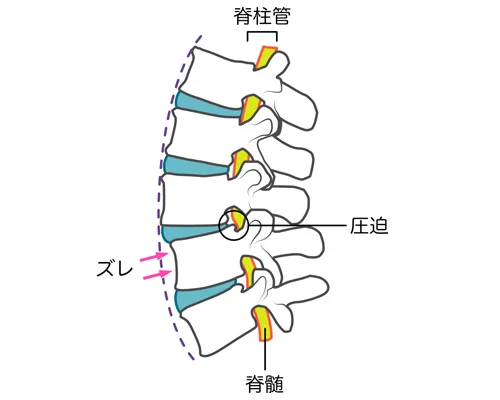 腰椎分離症とは？