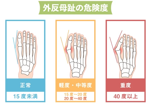 外反母趾とは？