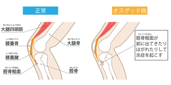 オスグッド病とは？