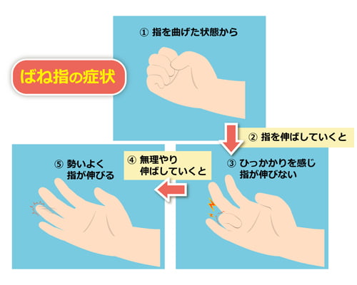 ばね指とは？