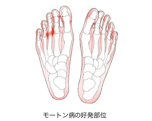モートン病とはどんな病気？