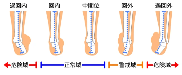 回内足の症状の説明