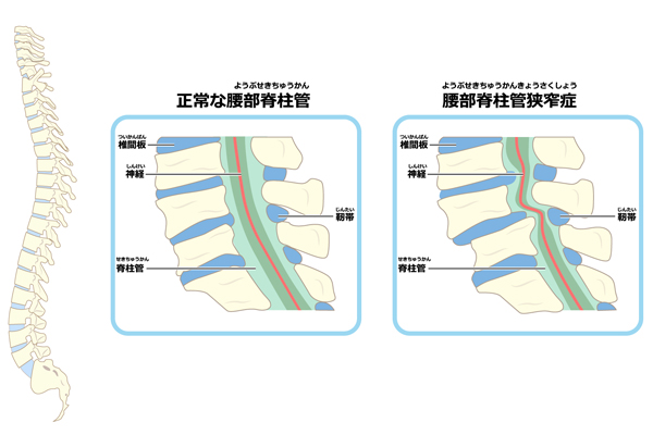 脊柱管狭窄症の骨格図