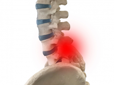 脊柱管狭窄症の骨画像