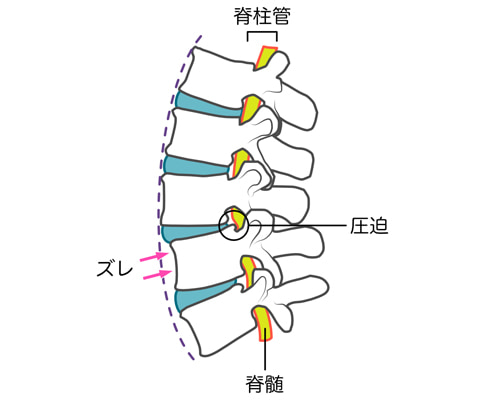 腰椎分離症とは？