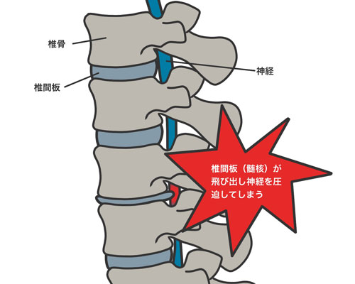 腰椎椎間板ヘルニアとは？