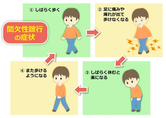 間欠性跛行とは？