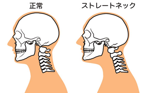 ストレートネックとは？